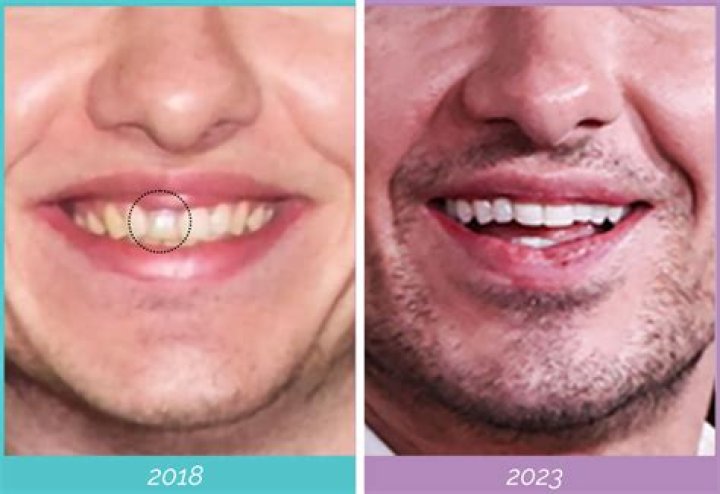 Barry Keoghan and Plastic Surgery: Truth Regarding Barry Keoghan's Cosmetic Procedures. - SarkariResult