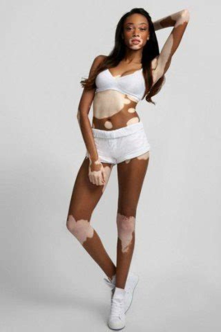Winnie Harlow Height, Weight, Measurements, Bra Size, Shoe Size